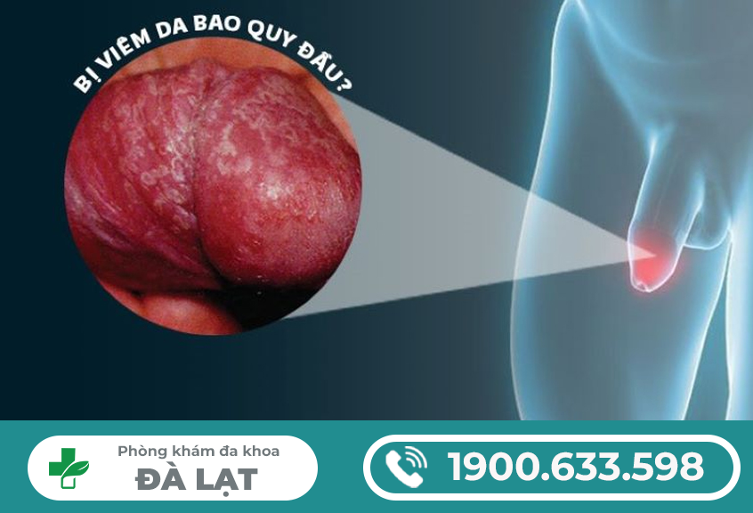 CÁCH CHỮA BỆNH VIÊM BAO QUY ĐẦU